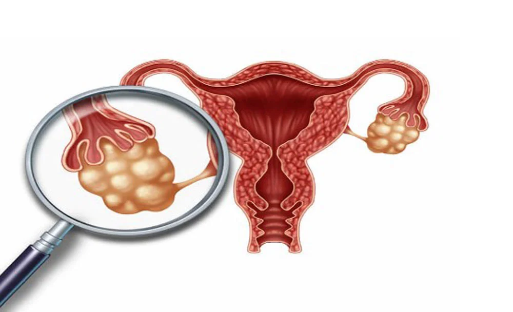 علاج تكيس المبايض في عمان